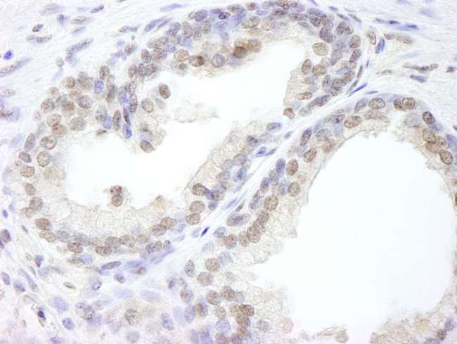 USP47 Antibody - Detection of Human USP47 by Immunohistochemistry. Sample: FFPE section of human prostate carcinoma. Antibody: Affinity purified rabbit anti-USP47 used at a dilution of 1:500.
