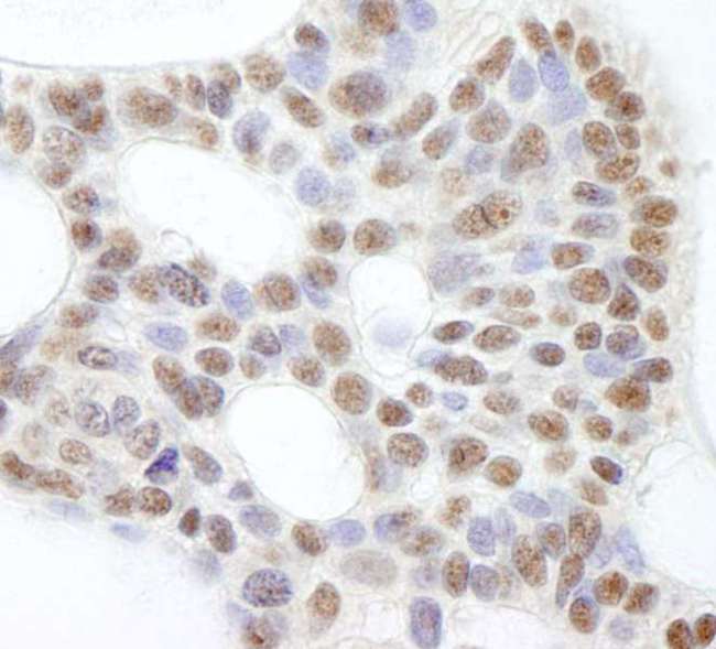 USP47 Antibody - Detection of Human USP47 by Immunohistochemistry. Sample: FFPE section of human basal cell carcinoma. Antibody: Affinity purified rabbit anti-USP47 used at a dilution of 1:500.