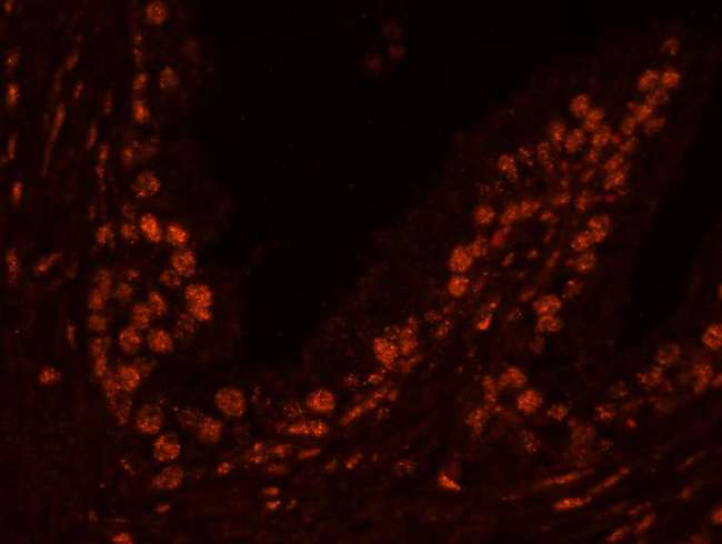 USP47 Antibody - Detection of human USP47 by immunohistochemistry. Sample: FFPE section of human prostate adenocarcinoma. Antibody: Affinity purified rabbit anti-USP47 used at a dilution of 1:100. Detection: Red-fluorescent Alexa Fluor® 555 goat anti-rabbit IgG (Invitrogen) used at a dilution of 1:500.