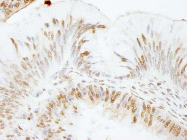 USP47 Antibody - Detection of Human USP47 by Immunohistochemistry. Sample: FFPE section of human colon carcinoma. Antibody: Affinity purified rabbit anti-USP47 used at a dilution of 1:1000 (1 ug/ml). Detection: DAB.