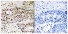 USP48 Antibody - Immunohistochemistry analysis of paraffin-embedded human colon carcinoma tissue, using USP48 Antibody. The picture on the right is blocked with the synthesized peptide.