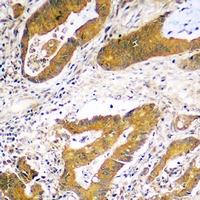 USP48 Antibody - Immunohistochemical analysis of USP48 staining in human colon cancer formalin fixed paraffin embedded tissue section. The section was pre-treated using heat mediated antigen retrieval with sodium citrate buffer (pH 6.0). The section was then incubated with the antibody at room temperature and detected using an HRP polymer system. DAB was used as the chromogen. The section was then counterstained with hematoxylin and mounted with DPX.