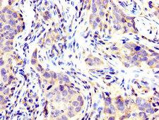 USP48 Antibody - Immunohistochemistry image at a dilution of 1:200 and staining in paraffin-embedded human pancreatic cancer performed on a Leica BondTM system. After dewaxing and hydration, antigen retrieval was mediated by high pressure in a citrate buffer (pH 6.0) . Section was blocked with 10% normal goat serum 30min at RT. Then primary antibody (1% BSA) was incubated at 4 °C overnight. The primary is detected by a biotinylated secondary antibody and visualized using an HRP conjugated SP system.