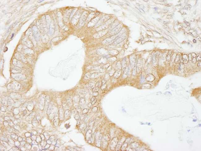 USP5 Antibody - Detection of Human USP5/IsoT by Immunohistochemistry. Sample: FFPE section of human colon carcinoma. Antibody: Affinity purified rabbit anti-USP5/IsoT used at a dilution of 1:100.