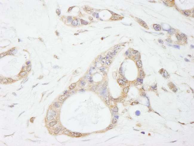 USP5 Antibody - Detection of Human USP5/IsoT by Immunohistochemistry. Sample: FFPE section of human ovarian carcinoma. Antibody: Affinity purified rabbit anti-USP5/IsoT used at a dilution of 1:500.
