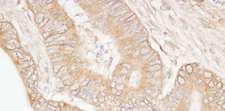 USP5 Antibody - Detection of Human USP5/IsoT by Immunohistochemistry. Sample: FFPE section of human colon carcinoma. Antibody: Affinity purified rabbit anti-USP5/IsoT used at a dilution of 1:1000 (1 ug/ml). Detection: DAB.