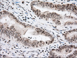 USP5 Antibody - IHC of paraffin-embedded Adenocarcinoma of Human colon tissue using anti-USP5 mouse monoclonal antibody. (Dilution 1:50).