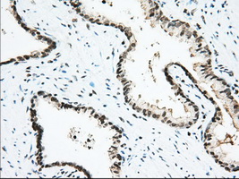 USP5 Antibody - IHC of paraffin-embedded Carcinoma of Human prostate tissue using anti-USP5 mouse monoclonal antibody. (Dilution 1:50).