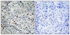 USP53 Antibody - Immunohistochemistry analysis of paraffin-embedded human breast carcinoma, using USP53 Antibody. The picture on the right is blocked with the synthesized peptide.