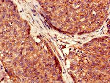 USP6 / HRP1 Antibody - Immunohistochemistry of paraffin-embedded human ovarian cancer using USP6 Antibody at dilution of 1:100