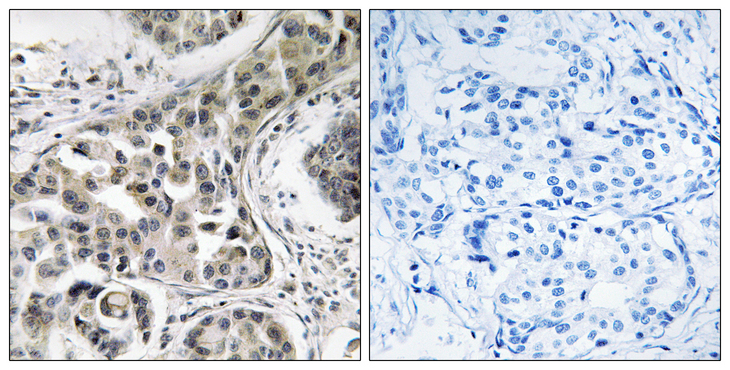 USP6NL Antibody - Immunohistochemistry analysis of paraffin-embedded human breast carcinoma, using USP6NL Antibody. The picture on the right is blocked with the synthesized peptide.