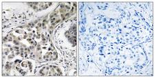 USP6NL Antibody - Peptide - + Immunohistochemistry analysis of paraffin-embedded human breast carcinoma tissue using USP6NL antibody.