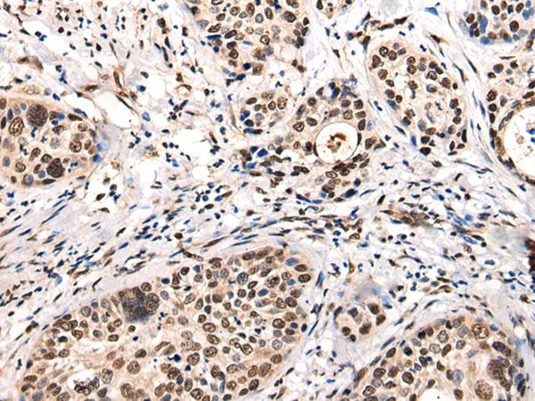 USP6NL Antibody - Immunohistochemistry of paraffin-embedded Human cervical cancer tissue  using USP6NL Polyclonal Antibody at dilution of 1:30(×200)