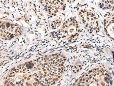 USP6NL Antibody - Immunohistochemistry of paraffin-embedded Human cervical cancer tissue  using USP6NL Polyclonal Antibody at dilution of 1:30(×200)