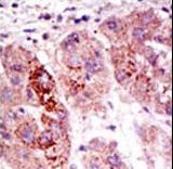 USP7 / HAUSP Antibody - Formalin-fixed and paraffin-embedded human cancer tissue reacted with the primary antibody, which was peroxidase-conjugated to the secondary antibody, followed by AEC staining. This data demonstrates the use of this antibody for immunohistochemistry; clinical relevance has not been evaluated. BC = breast carcinoma; HC = hepatocarcinoma.