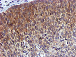 USP7 / HAUSP Antibody - IHC of paraffin-embedded Carcinoma of Human bladder tissue using anti-USP7 mouse monoclonal antibody. (Heat-induced epitope retrieval by 10mM citric buffer, pH6.0, 100C for 10min).