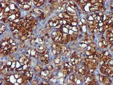 USP7 / HAUSP Antibody - IHC of paraffin-embedded Carcinoma of Human kidney tissue using anti-USP7 mouse monoclonal antibody. (Heat-induced epitope retrieval by 10mM citric buffer, pH6.0, 100C for 10min).