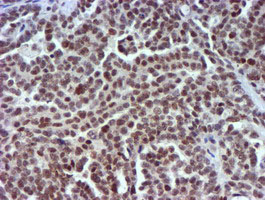 USP7 / HAUSP Antibody - IHC of paraffin-embedded Adenocarcinoma of Human ovary tissue using anti-USP7 mouse monoclonal antibody.