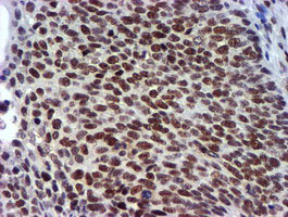 USP7 / HAUSP Antibody - IHC of paraffin-embedded Carcinoma of Human bladder tissue using anti-USP7 mouse monoclonal antibody.
