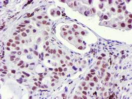 USP7 / HAUSP Antibody - IHC of paraffin-embedded Carcinoma of Human lung tissue using anti-USP7 mouse monoclonal antibody.