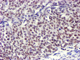USP7 / HAUSP Antibody - IHC of paraffin-embedded Adenocarcinoma of Human ovary tissue using anti-USP7 mouse monoclonal antibody.