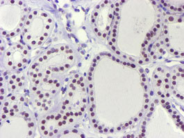 USP7 / HAUSP Antibody - IHC of paraffin-embedded Carcinoma of Human thyroid tissue using anti-USP7 mouse monoclonal antibody.