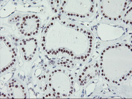 USP7 / HAUSP Antibody - IHC of paraffin-embedded Carcinoma of Human thyroid tissue using anti-USP7 mouse monoclonal antibody. (Heat-induced epitope retrieval by 10mM citric buffer, pH6.0, 100C for 10min).