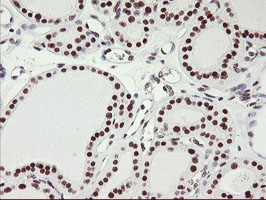 USP7 / HAUSP Antibody - IHC of paraffin-embedded Carcinoma of Human thyroid tissue using anti-USP7 mouse monoclonal antibody.