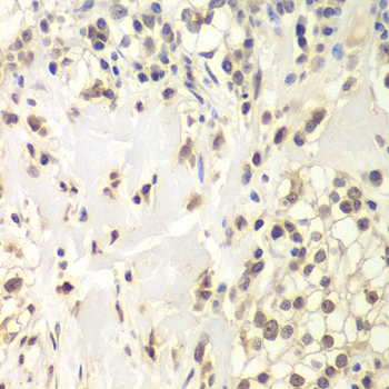 USP7 / HAUSP Antibody - Immunohistochemistry of paraffin-embedded human kidney cancer tissue.