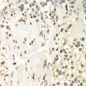 USP7 / HAUSP Antibody - Immunohistochemistry of paraffin-embedded human kidney cancer tissue.