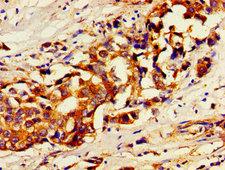 USP7 / HAUSP Antibody - Immunohistochemistry image of paraffin-embedded human breast cancer at a dilution of 1:100