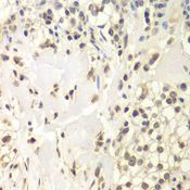 USP7 / HAUSP Antibody - Immunohistochemistry of paraffin-embedded human kidney cancer using USP7 antibody at dilution of 1:200 (40x lens).