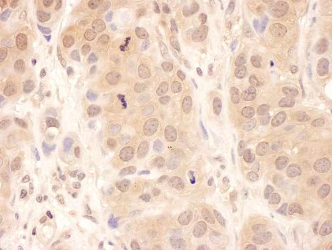 USP8 / UBPY Antibody - Detection of Human USP8 by Immunohistochemistry. Sample: FFPE section of human breast carcinoma. Antibody: Affinity purified rabbit anti-USP8 used at a dilution of 1:200 (1 ug/ml). Detection: DAB.