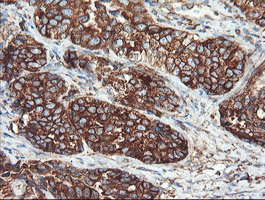USP9X / FAM Antibody - IHC of paraffin-embedded Adenocarcinoma of Human ovary tissue using anti-USP9X mouse monoclonal antibody.