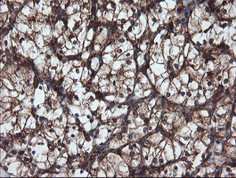 USP9X / FAM Antibody - IHC of paraffin-embedded Carcinoma of Human kidney tissue using anti-USP9X mouse monoclonal antibody.