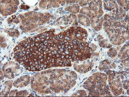 USP9X / FAM Antibody - IHC of paraffin-embedded Carcinoma of Human pancreas tissue using anti-USP9X mouse monoclonal antibody.