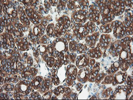 USP9X / FAM Antibody - IHC of paraffin-embedded Carcinoma of Human thyroid tissue using anti-USP9X mouse monoclonal antibody.