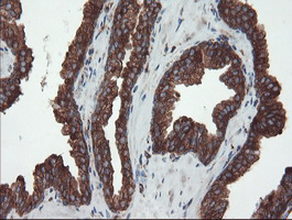 USP9X / FAM Antibody - IHC of paraffin-embedded Carcinoma of Human prostate tissue using anti-USP9X mouse monoclonal antibody.
