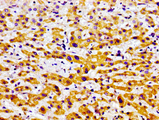 USP9X / FAM Antibody - Immunohistochemistry image of paraffin-embedded human liver cancer at a dilution of 1:100