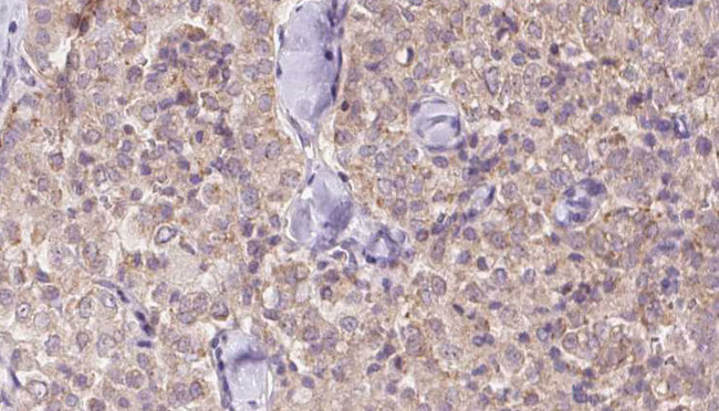 USP9X / FAM Antibody - 1:100 staining human thyroid carcinoma tissue by IHC-P. The sample was formaldehyde fixed and a heat mediated antigen retrieval step in citrate buffer was performed. The sample was then blocked and incubated with the antibody for 1.5 hours at 22°C. An HRP conjugated goat anti-rabbit antibody was used as the secondary.