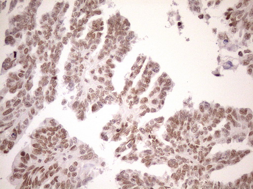 UTP11L Antibody - Immunohistochemical staining of paraffin-embedded Adenocarcinoma of Human ovary tissue using anti-UTP11L mouse monoclonal antibody. (Heat-induced epitope retrieval by 1mM EDTA in 10mM Tris buffer. (pH8.5) at 120°C for 3 min. (1:150)