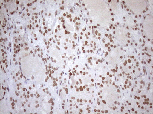 UTP11L Antibody - Immunohistochemical staining of paraffin-embedded Human thyroid tissue within the normal limits using anti-UTP11L mouse monoclonal antibody. (Heat-induced epitope retrieval by 1mM EDTA in 10mM Tris buffer. (pH8.5) at 120°C for 3 min. (1:150)