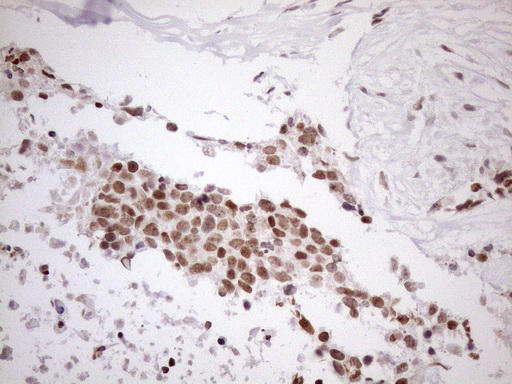 UTP11L Antibody - Immunohistochemical staining of paraffin-embedded Adenocarcinoma of Human endometrium tissue using anti-UTP11L mouse monoclonal antibody. (Heat-induced epitope retrieval by 1mM EDTA in 10mM Tris buffer. (pH8.5) at 120°C for 3 min. (1:150)