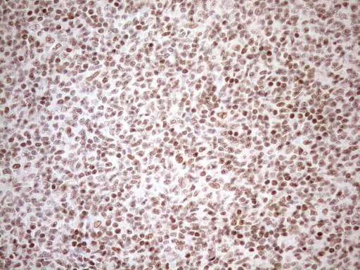 UTP11L Antibody - Immunohistochemical staining of paraffin-embedded Human lymphoma tissue using anti-UTP11L mouse monoclonal antibody. (Heat-induced epitope retrieval by 1mM EDTA in 10mM Tris buffer. (pH8.5) at 120°C for 3 min. (1:150)