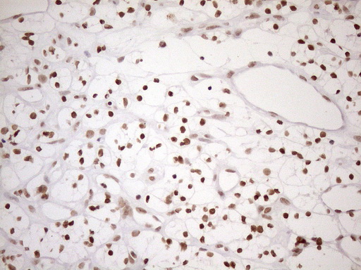 UTP11L Antibody - Immunohistochemical staining of paraffin-embedded Carcinoma of Human kidney tissue using anti-UTP11L mouse monoclonal antibody. (Heat-induced epitope retrieval by 1mM EDTA in 10mM Tris buffer. (pH8.5) at 120°C for 3 min. (1:150)