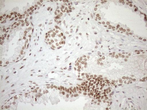 UTP11L Antibody - Immunohistochemical staining of paraffin-embedded Carcinoma of Human prostate tissue using anti-UTP11L mouse monoclonal antibody. (Heat-induced epitope retrieval by 1mM EDTA in 10mM Tris buffer. (pH8.5) at 120°C for 3 min. (1:150)