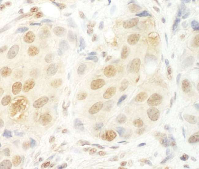 UTP6 Antibody - Detection of Human HCA66 by Immunohistochemistry. Sample: FFPE section of human breast carcinoma. Antibody: Affinity purified rabbit anti-HCA66 used at a dilution of 1:1000 (1 Detection: DAB.