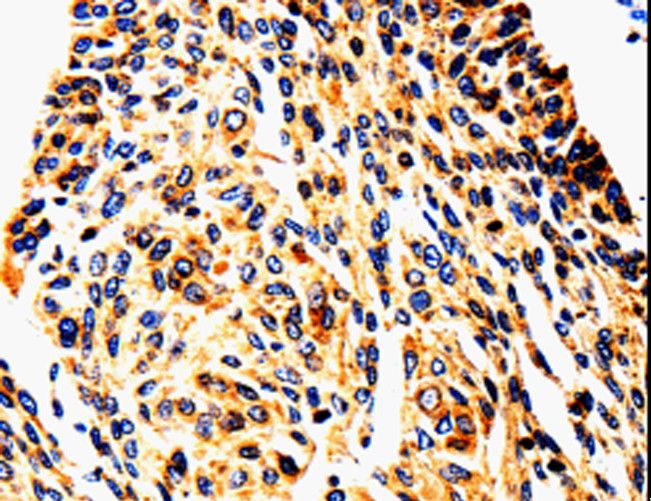UTS2 / Urotensin II Antibody - Immunohistochemistry of paraffin-embedded Human lung cancer using UTS2 Polyclonal Antibody at dilution of 1:50.