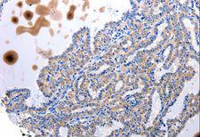 UTS2 / Urotensin II Antibody - Immunohistochemistry of paraffin-embedded Human stomach cancer using UTS2 Polyclonal Antibody at dilution of 1:100.