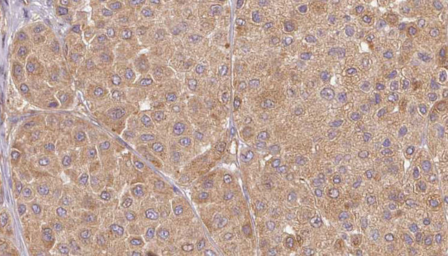 UTS2 / Urotensin II Antibody - 1:100 staining human Melanoma tissue by IHC-P. The sample was formaldehyde fixed and a heat mediated antigen retrieval step in citrate buffer was performed. The sample was then blocked and incubated with the antibody for 1.5 hours at 22°C. An HRP conjugated goat anti-rabbit antibody was used as the secondary.